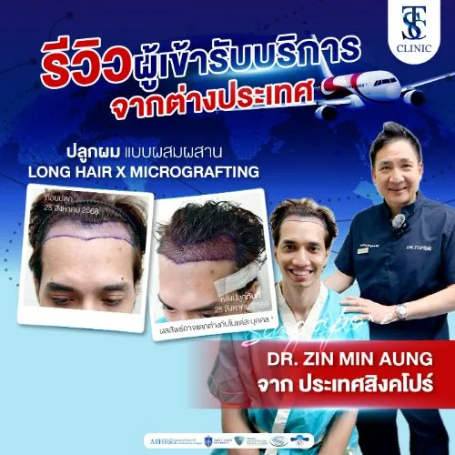 รีวิวการปลูกผมและการรักษาคนไข้จริง | THE SKIN CLINIC