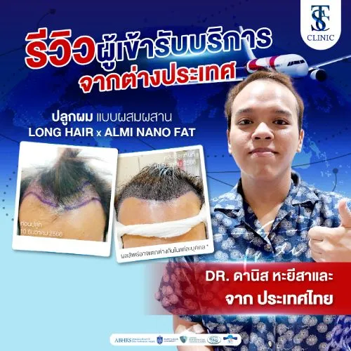 รีวิวการปลูกผมและการรักษาคนไข้จริง | THE SKIN CLINIC