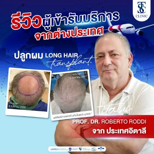 รีวิวการปลูกผมและการรักษาคนไข้จริง | THE SKIN CLINIC